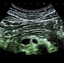 Виразкова хвороба шлунка і 12-палої кишки: симптоми, діагностика, лікування