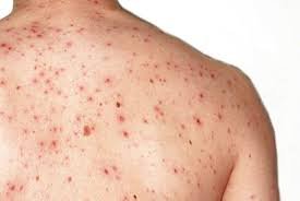 Хвороба Кір: Симптоми, Профілактика Та Лікування В Україні Хвороба Кір: Симптоми, Профілактика Та Лікування В Україні