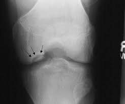 Хвороба Крона: діагностика та рентгенологічні обстеження Хвороба Крона: діагностика та рентгенологічні обстеження