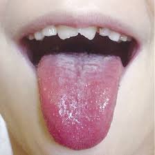 Хвороба язика: симптоми, діагностика та ефективні методи лікування Хвороба язика: симптоми, діагностика та ефективні методи лікування