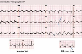 Дифузні зміни міокарда: що це таке і як їх виявити?