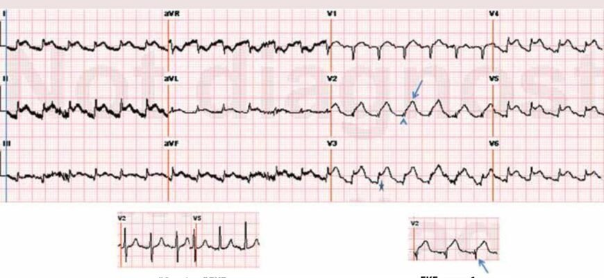 Дифузні зміни міокарда: що це таке і як їх виявити? Дифузні зміни міокарда: що це таке і як їх виявити?