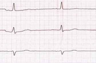 Дифузні зміни міокарда на ЕКГ: причини, діагностика та лікування