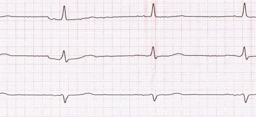Дифузні зміни міокарда на ЕКГ: причини, діагностика та лікування Дифузні зміни міокарда на ЕКГ: причини, діагностика та лікування