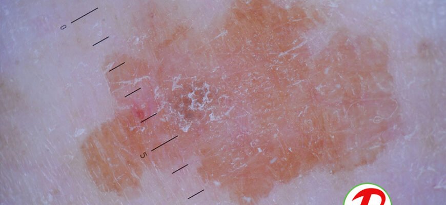 Хвороба Боуена: це стан шкіри, причини, симптоми та лікування