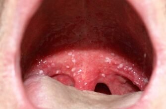 Ознаки та профілактика інфекцій горла: поради для здоров’я Ознаки та профілактика інфекцій горла: поради для здоров’я