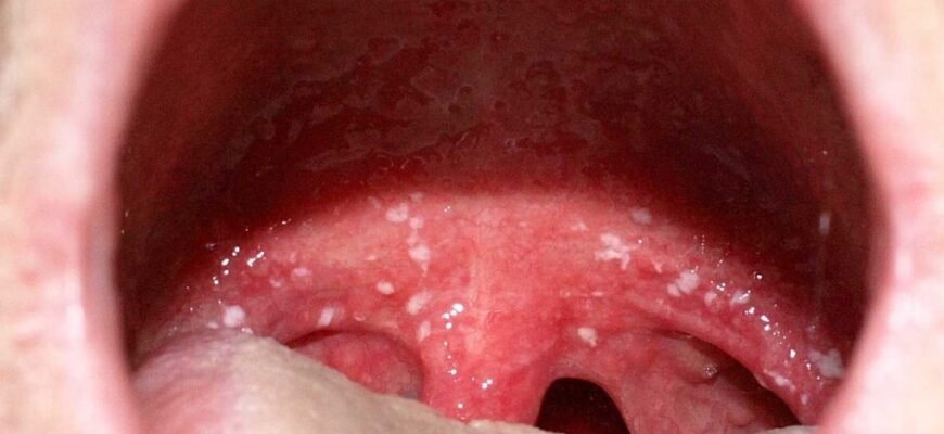 Ознаки та профілактика інфекцій горла: поради для здоров’я Ознаки та профілактика інфекцій горла: поради для здоров’я