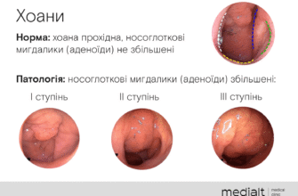Реабілітація після видалення аденоїдів у дитини: поради та етапи процесу