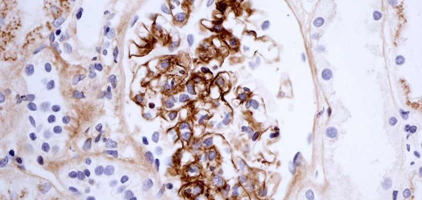 Хвороба Берже: симптоми, діагностика та сучасні методи лікування