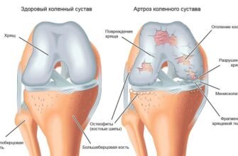 Хвороба колін: причини, симптоми та ефективні методи лікування