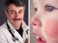 Обвітрені щоки у дитини: ефективні методи догляду та профілактики