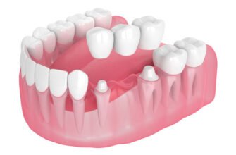 Чи можна ставити коронку на живий зуб: важливі аспекти та поради