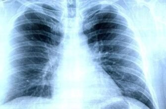Знімок легень при пневмонії: що показує та як розпізнати хворобу?