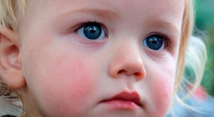 Лопають капіляри на обличчі у дитини: причини та лікування