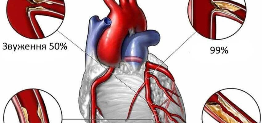 Ішемічна хвороба серця: симптоми, що варто знати для здоров’я