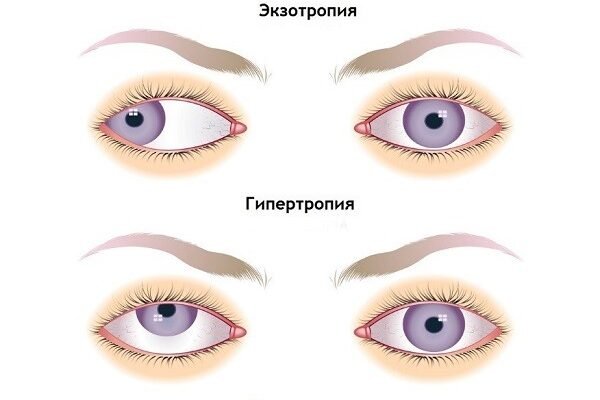Що робити, якщо у дитини косить одне око: поради батькам