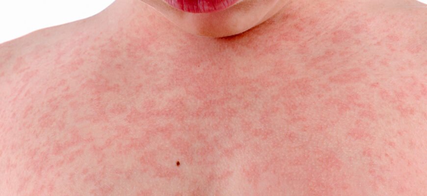 Як виглядає лишай у дитини: основні ознаки та симптоми