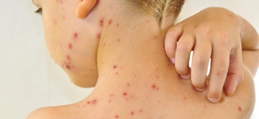Дрібна червона висипка у дитини: причини, лікування та профілактика