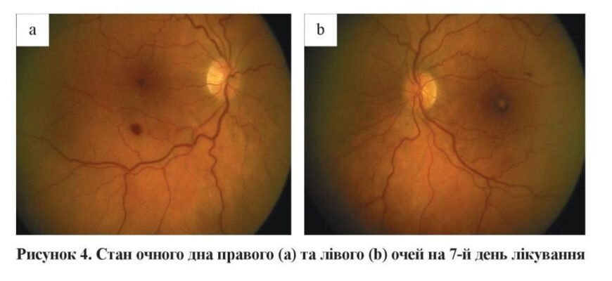 Фонова ретинопатія: причини та зміни в ретинальних судинах