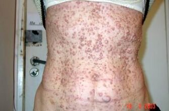 Хвороба Реклінгаузена: симптоми, діагностика та лікування нейрофіброматозу