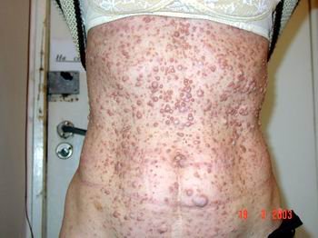 Хвороба Реклінгаузена: симптоми, діагностика та лікування нейрофіброматозу Хвороба Реклінгаузена: симптоми, діагностика та лікування нейрофіброматозу