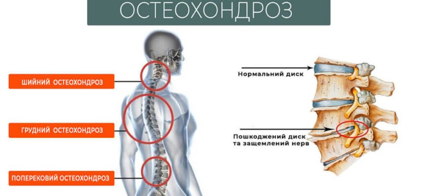 Дистрофічні зміни хребта: причини, симптоми та лікування