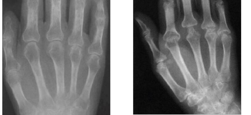 Кістково деструктивні зміни: що це і як їх розпізнати?