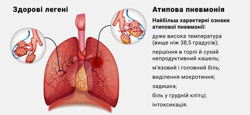 Ознаки пневмонії у дитини: як розпізнати та вчасно лікувати