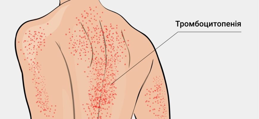 Тромбоцити підвищені у дитини: причини та методи лікування