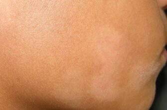 Як лікувати лишай у дитини в домашніх умовах: поради та засоби