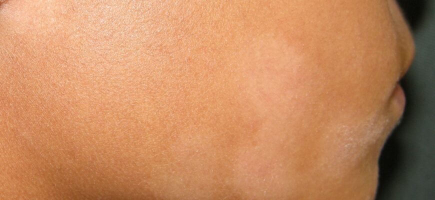 Як лікувати лишай у дитини в домашніх умовах: поради та засоби Як лікувати лишай у дитини в домашніх умовах: поради та засоби