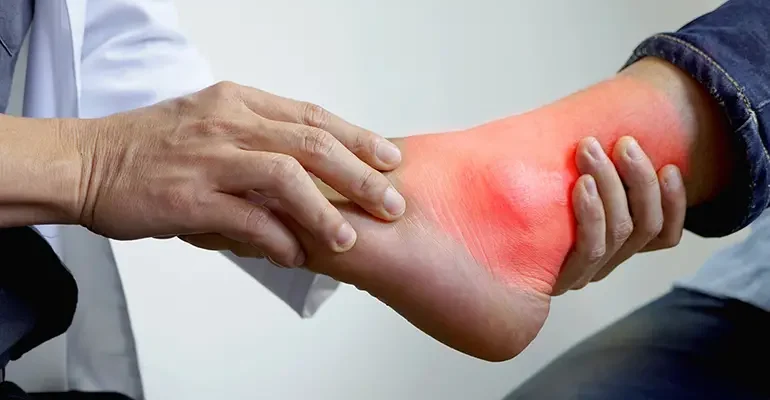 Хвороба подагра: основні симптоми у чоловіків та рекомендації лікування