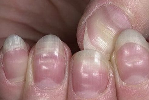 Які є хвороби нігтів: детальний огляд та методи лікування Які є хвороби нігтів: детальний огляд та методи лікування
