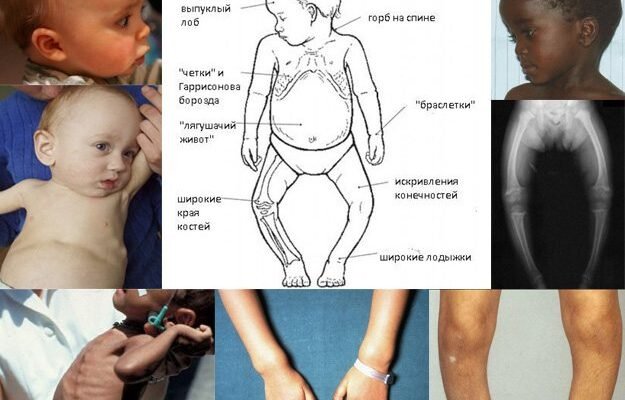Як зрозуміти, що у дитини рахіт: основні симптоми та ознаки
