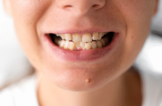 Неправильний прикус у дитини: причини, наслідки та рішення