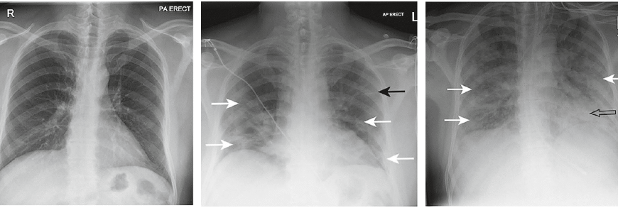 Пневмофібротичні зміни в легенях: причини, діагностика, лікування