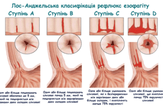 Ефективні методи лікування рефлюксу у дитини: поради та рекомендації