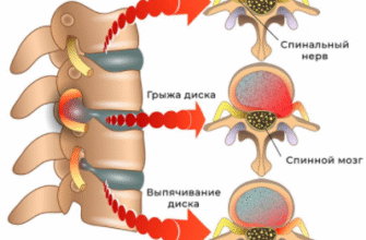 Дегенеративні зміни хребта: що це таке та як з ними боротися?