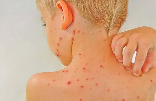 Як визначити на що алергія у дитини: поради та методи діагностики