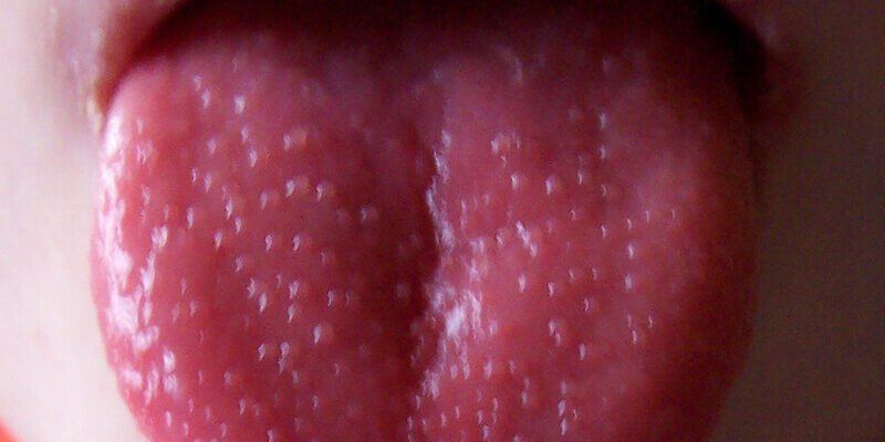 Висип на язиці у дитини: причини, симптоми та лікування Висип на язиці у дитини: причини, симптоми та лікування