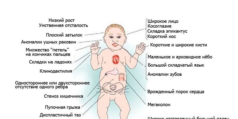 Що таке синдром Дауна? Причини та ознаки генетичної аномалії