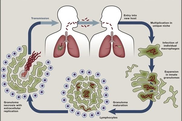 Метатуберкульозні зміни легень: причини, симптоми й діагностика