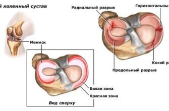 Дегенеративні зміни менісків: симптоми, діагностика та лікування