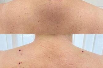 Горб на шиї у дитини: причини, наслідки та методи лікування