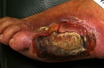 Що таке гангрена: причини, симптоми та методи лікування хвороби