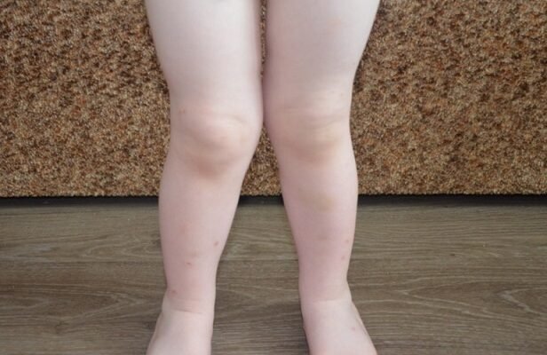 Криві ноги у дитини: причини, наслідки та методи виправлення