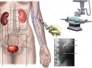 Сечокам’яна хвороба: причини, симптоми та лікування ефективно
