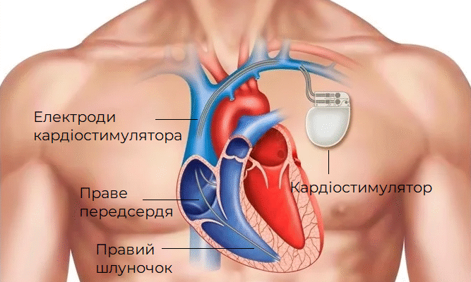 Які пільги після встановлення кардіостимулятора в Україні?