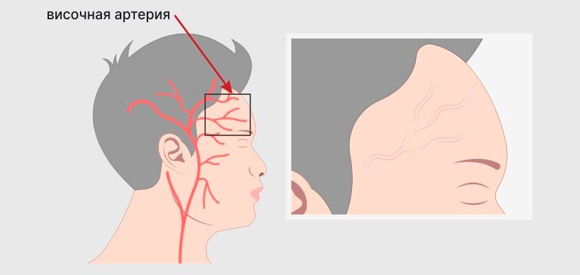 Хвороба Хортона: Симптоми, Діагностика і Методи Лікування