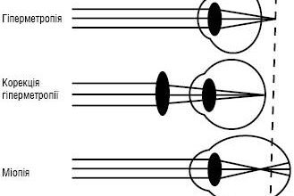 Різниця рефракції у двох головних меридіанах: що потрібно знати?